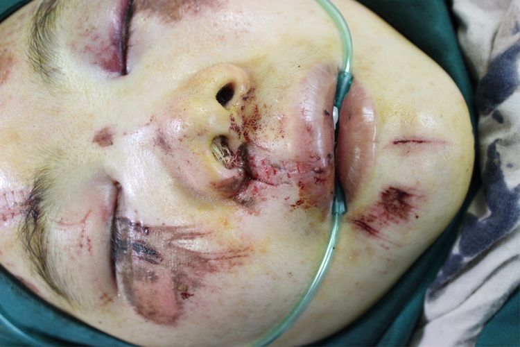 面部外伤后初期疤痕凸起怎么修复,面部外伤凹陷疤痕怎么去除