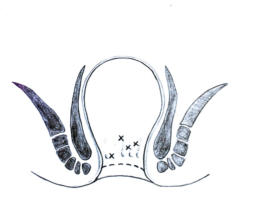 中医肛肠科适宜技术规范,中医肛肠疗法大全