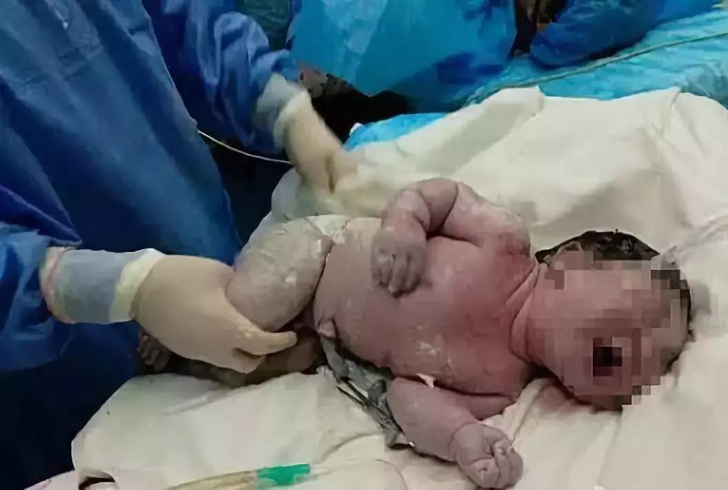 顺产好还是剖宫产好应该怎么选,生孩子到底顺产还是剖腹疼