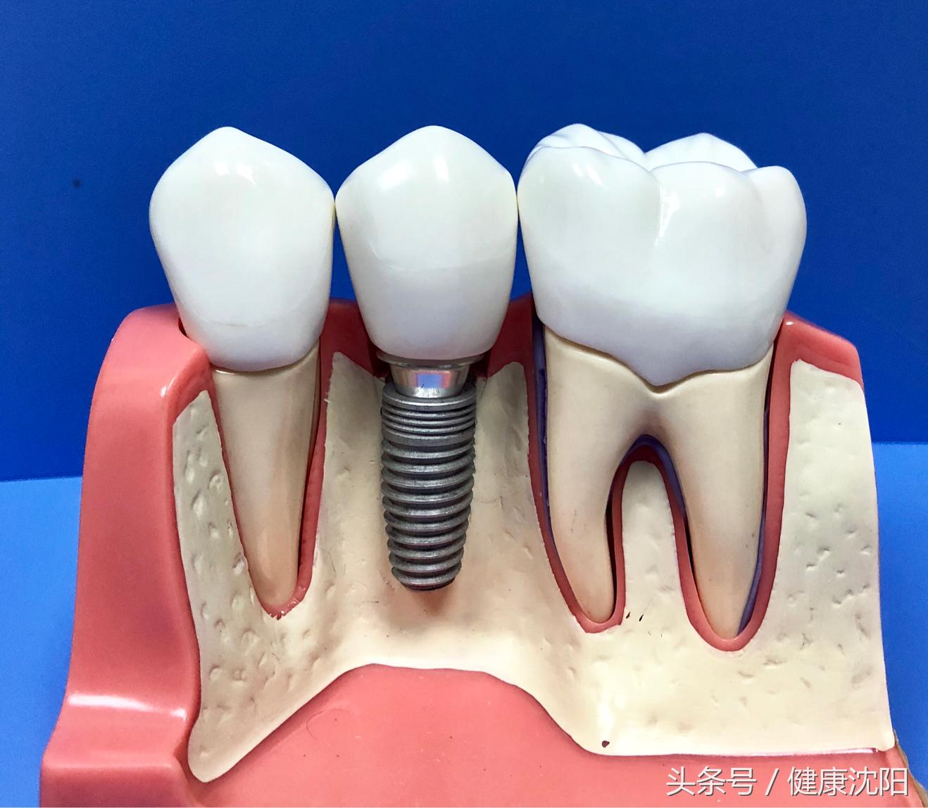 拔牙后一般多久能镶牙,拔牙过后一般多久才能镶牙