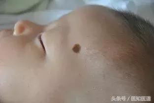 身上的痣会不会癌变一张图告诉你,身体上7种痣容易癌变
