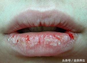 冬季嘴唇干裂适合喝什么汤,冬季孩子嘴唇红肿干裂老是舔