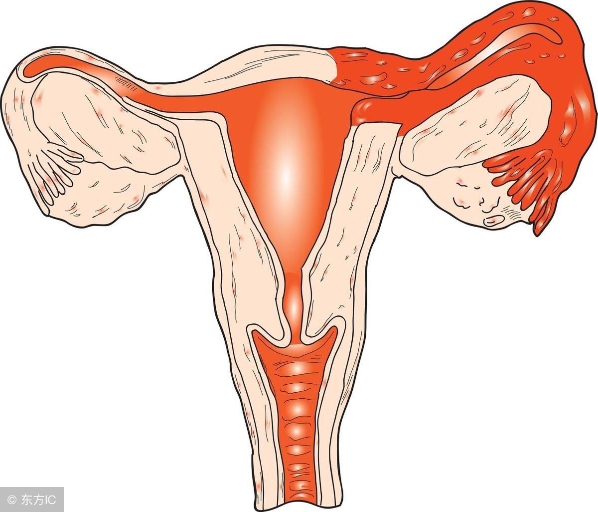 宫颈接触性出血一定是宫颈癌吗,宫颈糜烂接触性出血怎么办