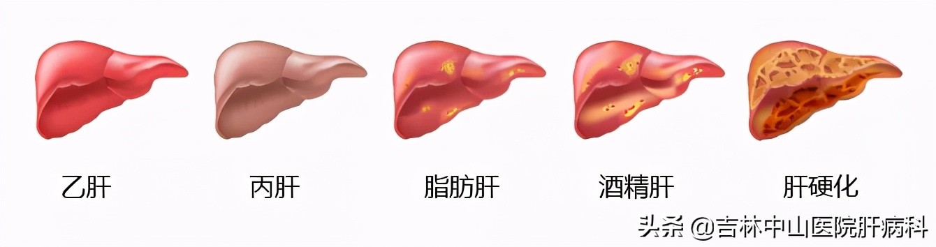 肝功能异常转氨酶高,肝功能异常什么意思