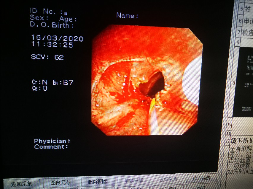 经支气管镜球囊扩张治疗气道狭窄,支气管镜球囊扩张操作视频