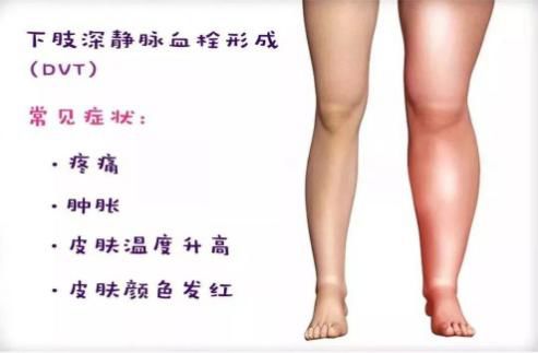 孕妈预防秘籍,孕妈防止血栓按摩腿部