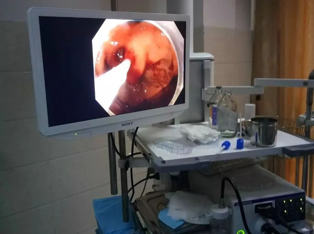 内镜下消化道出血的治疗简报,消化道出血内镜下止血治疗处方