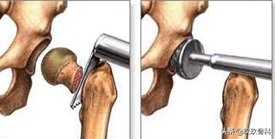 老年人针对膝骨关节炎的康复训练,膝骨关节炎怎么治疗效果最佳