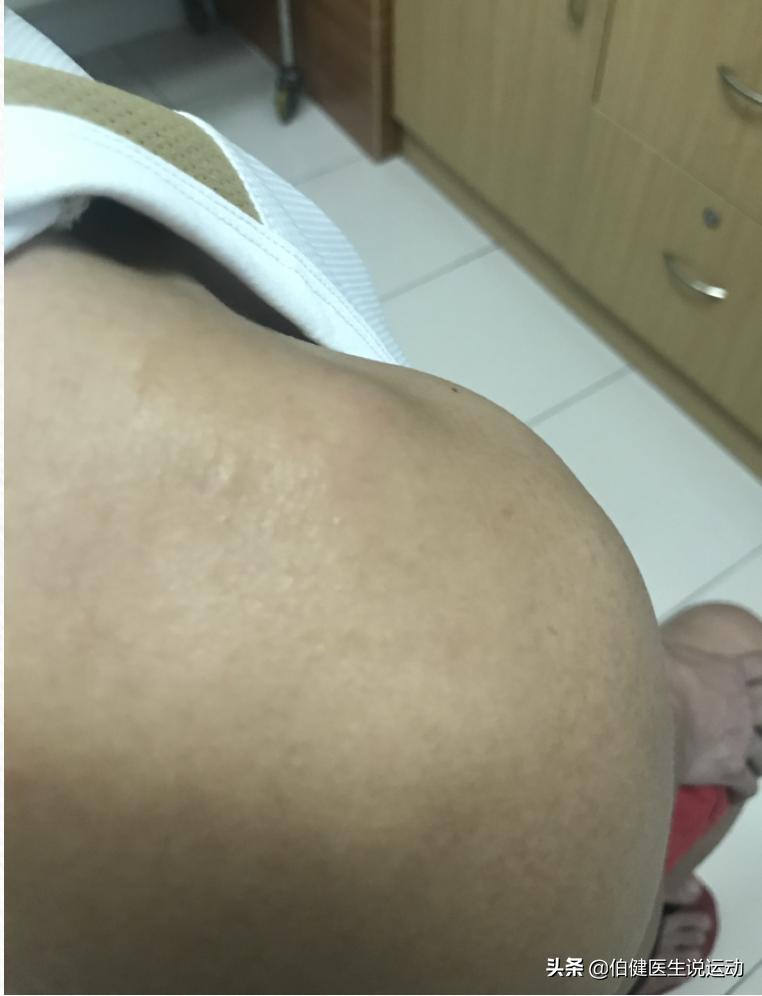 再论肩峰凸起的原因,肩峰凸起是怎么造成的