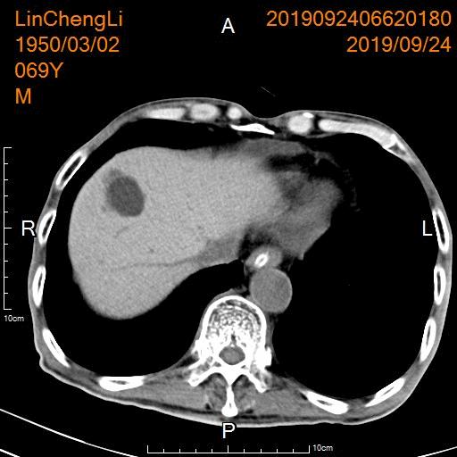 胃癌晚期化疗一次多少钱,胃癌晚期不化疗用靶向药