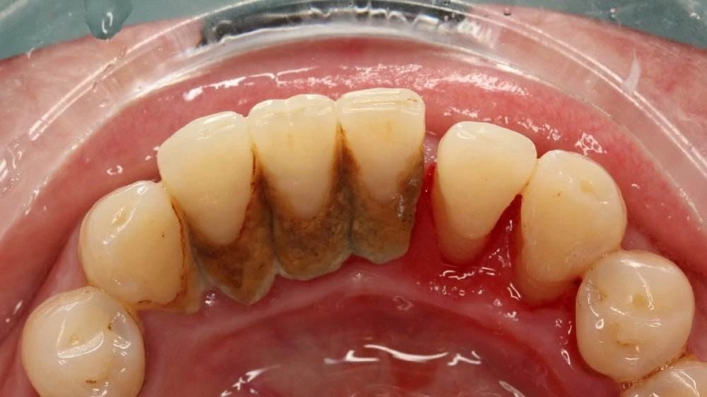 牙龈用力一吸牙就出血是破损吗,吸了一下牙齿牙龈就出血了