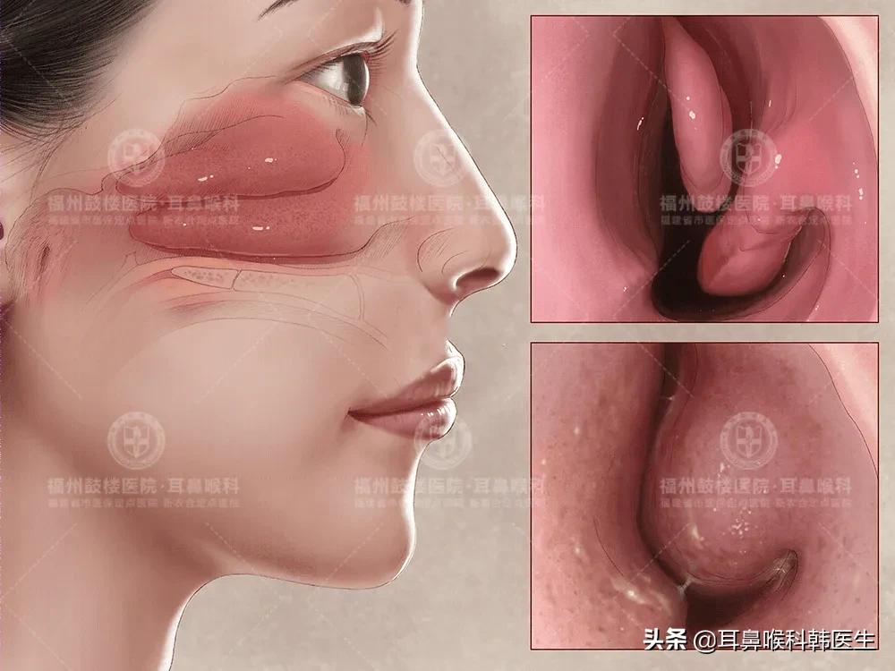 鼻炎自愈的最佳办法永久不犯鼻炎,鼻炎不论什么方法都不好