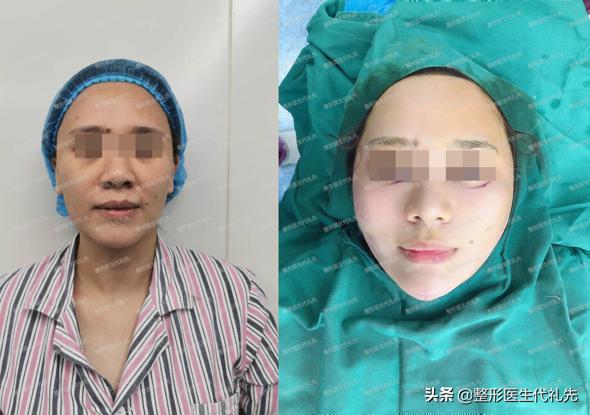 减肥后拉皮后的皮肤会松弛吗,减肥后皮肤松弛下垂怎么办图片