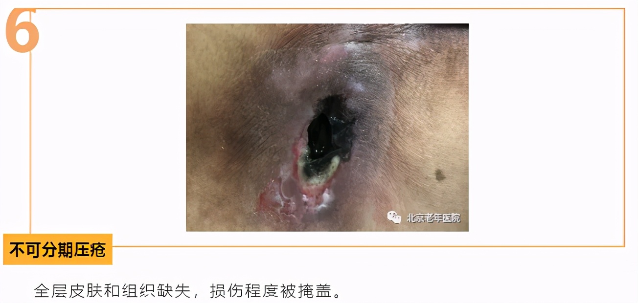 老年人防压疮的饮食照护原则,三度压疮老年人的家庭照护