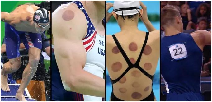 神秘“东方力量”再现奥运会!原来中医拔罐有这么多好处