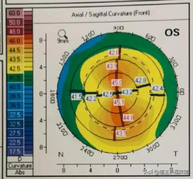 孩子眼睛近视加散光如何治疗,儿童视力散光180度怎么办