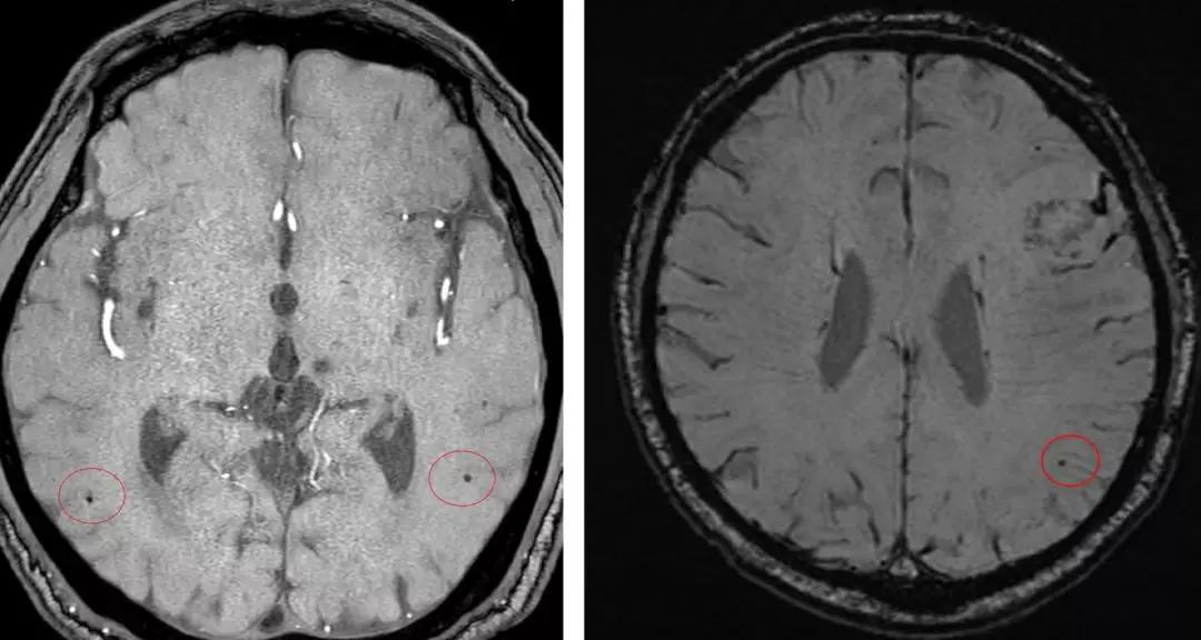 脑梗溶栓后脑出血脑疝晚期,阿替普酶溶栓后脑出血处理