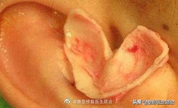 鼻整形手术风险,鼻整形副作用