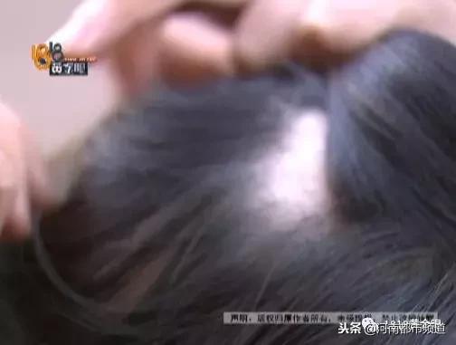 杭州漂亮女孩扎马尾头皮一下秃了四块！她怀疑那次在理发店……