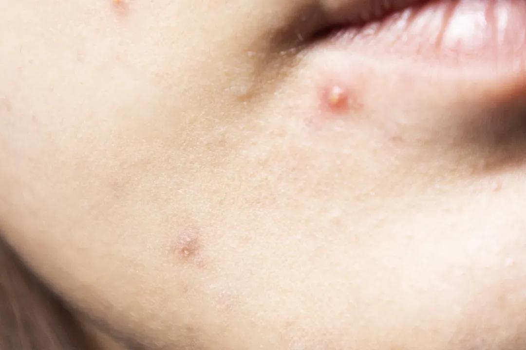 让无数姑娘无从下手的痘印，皮肤科医生有了解决新招