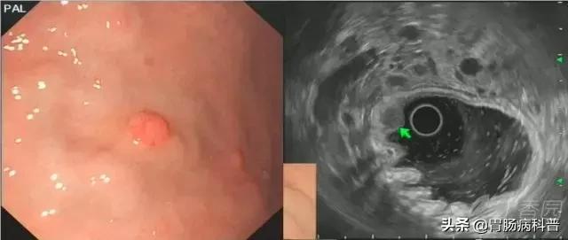 胃癌手术后一年胃镜说胃粘膜隆起,胃镜报告有隆起