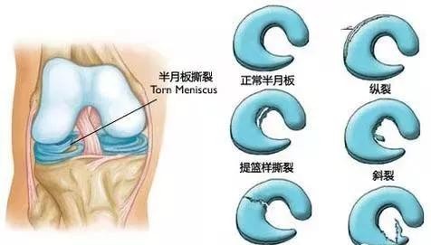 膝关节半月板损伤2-3度怎样锻炼好,健康科普大赛骨质疏松
