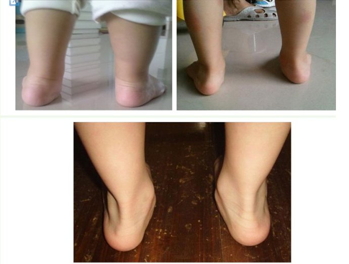 足外翻最佳治疗时间几岁,足外翻最佳治疗时间