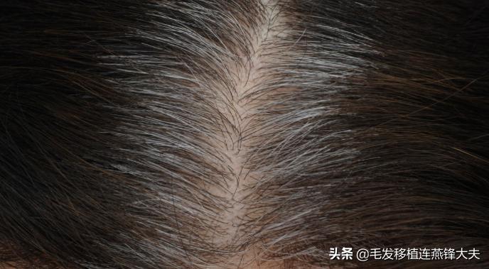 毛囊脱发怎么治疗最有效,治疗脱发有什么办法吗