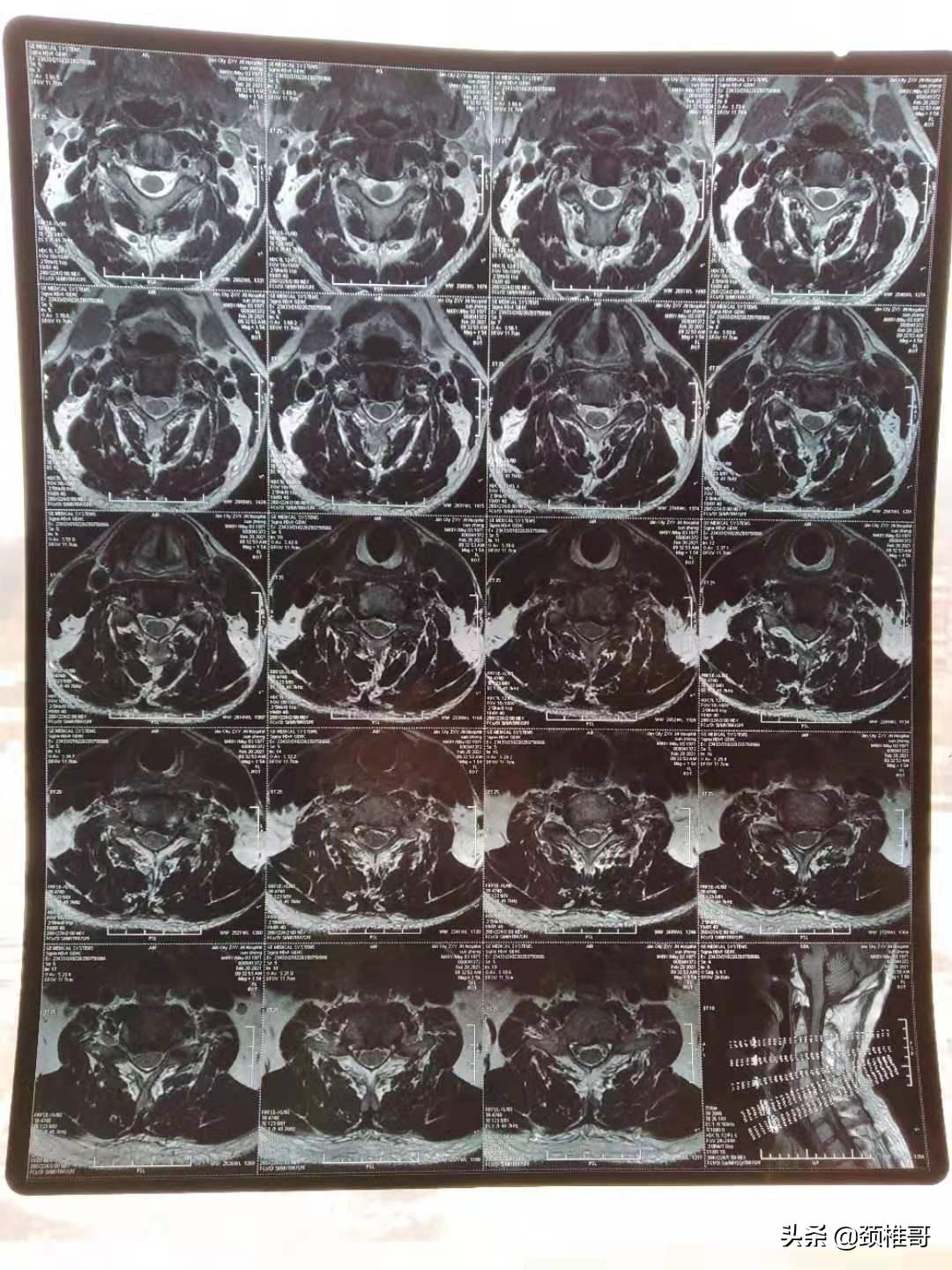 打篮球被撞胸口动一下就疼没有肿,打篮球被撞得锁骨一边疼
