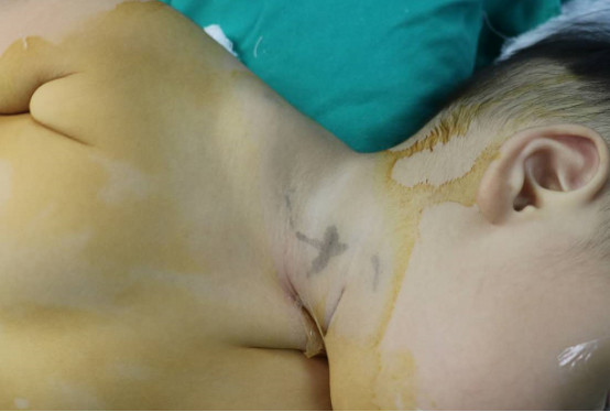 小孩海绵状血管瘤开颅手术,9个小时切除罕见肿瘤