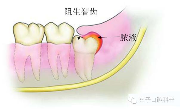 拔智齿十大危害,拔智齿利与弊