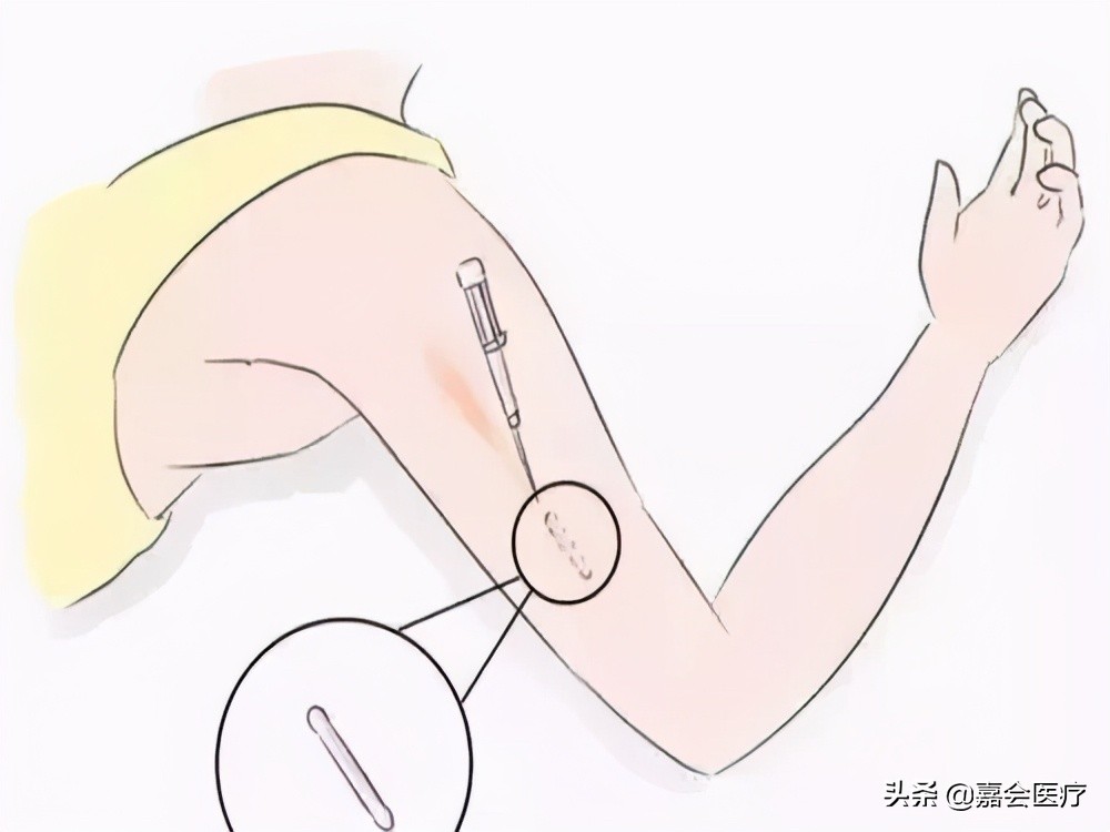 皮下埋植避孕药男的能做吗,未婚未孕可以皮下埋植避孕吗