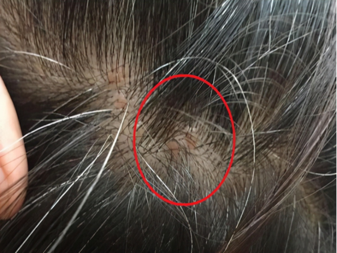 头皮有血疙瘩是什么病,头皮长疙瘩怎么回事怎么解决