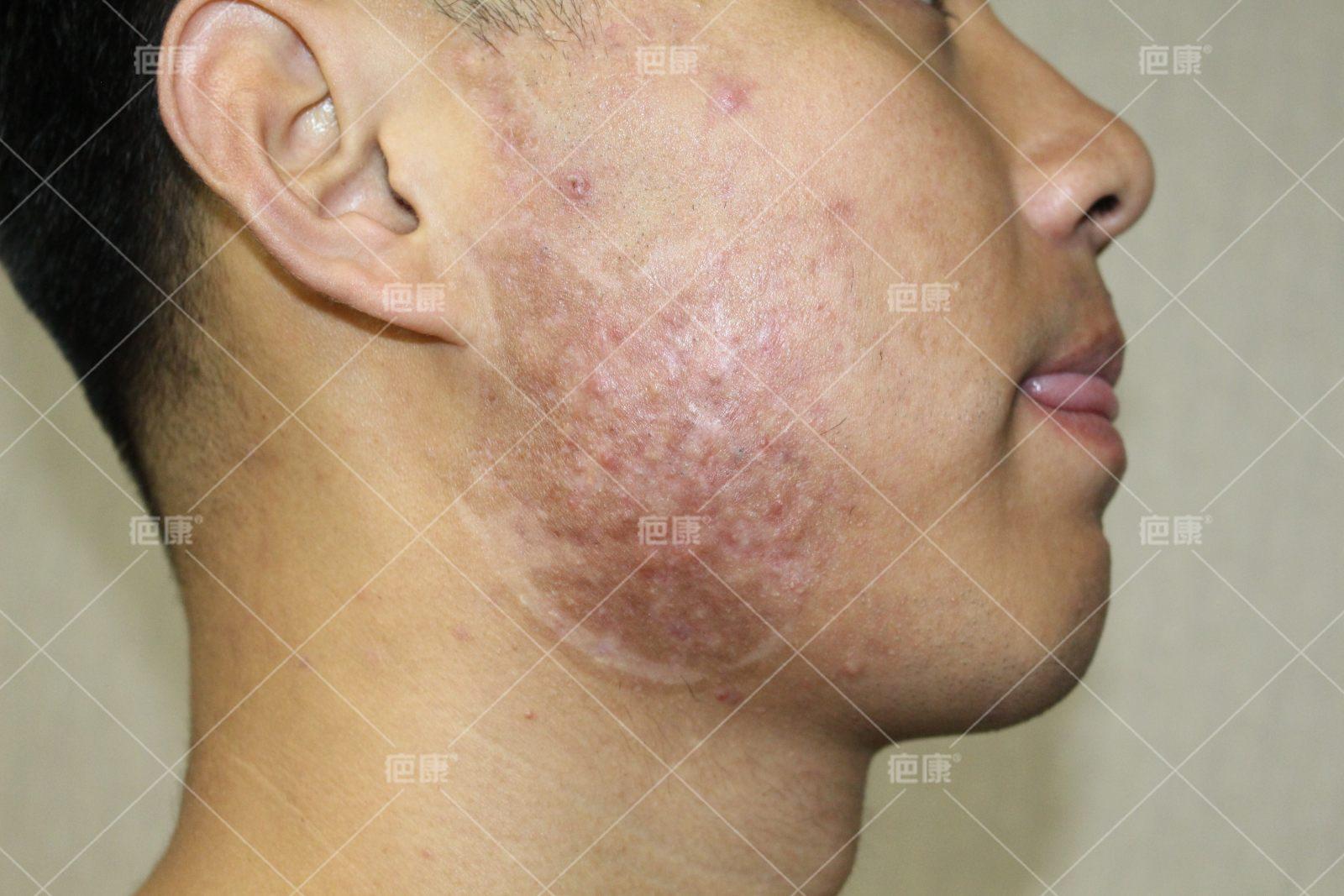 疤康治疗疼吗,疤康恢复过程视频