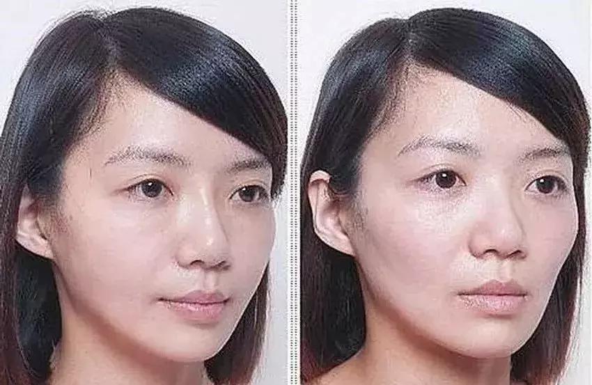 整牙一年半牙缝大,整牙一年了牙间距很大