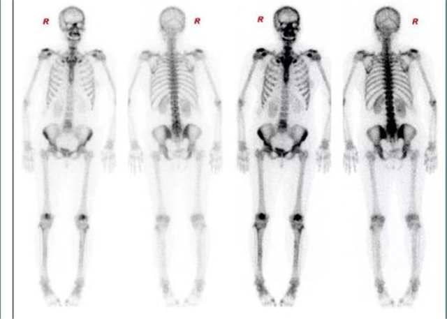 乳腺癌切除后还会得其它癌吗,乳腺癌术后并发症的护理及预防