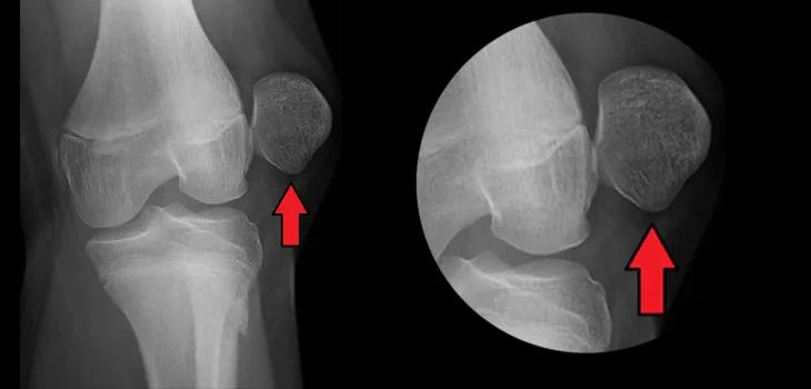 狗狗髌骨脱位的最佳治疗方法,为什么狗狗髌骨脱位还能站起来
