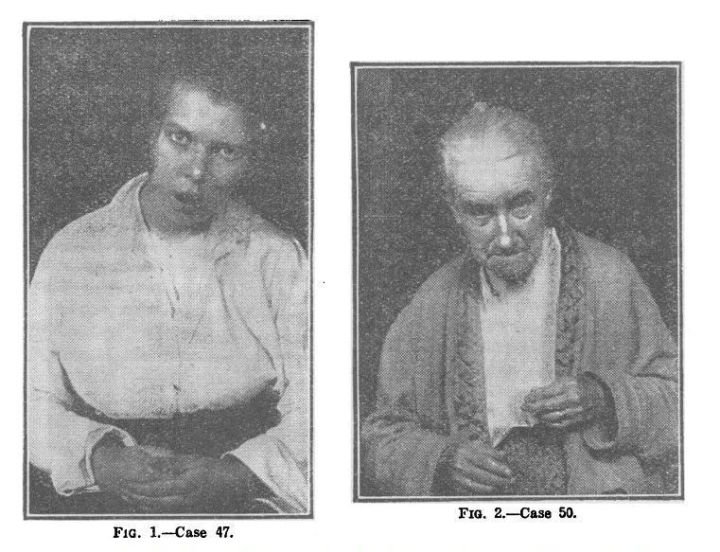 绁炵鏄忕潯鐥呯殑鐪熺浉,绁炵鐨勯粦姝荤梾娑堝け涔嬭皽