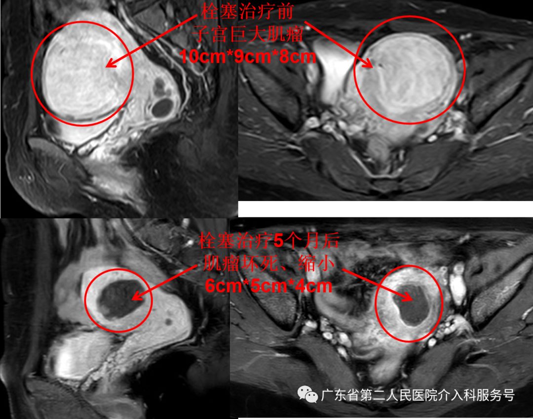 针眼妙方治疗，1个月后让淋沥不净的“大姨妈”如期结束