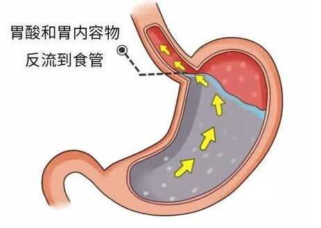 胃食管反流治疗药物有哪些,治疗胃食管反流病的首选药物是