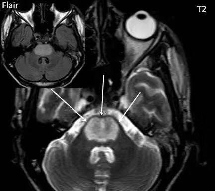 脱髓鞘病变是什么病怎么读,脱髓鞘病变的特征