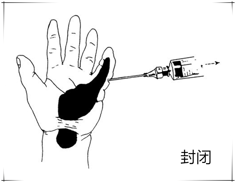 手指狭窄性腱鞘炎挂号去什么科,手指腱鞘炎按痛处吱吱响