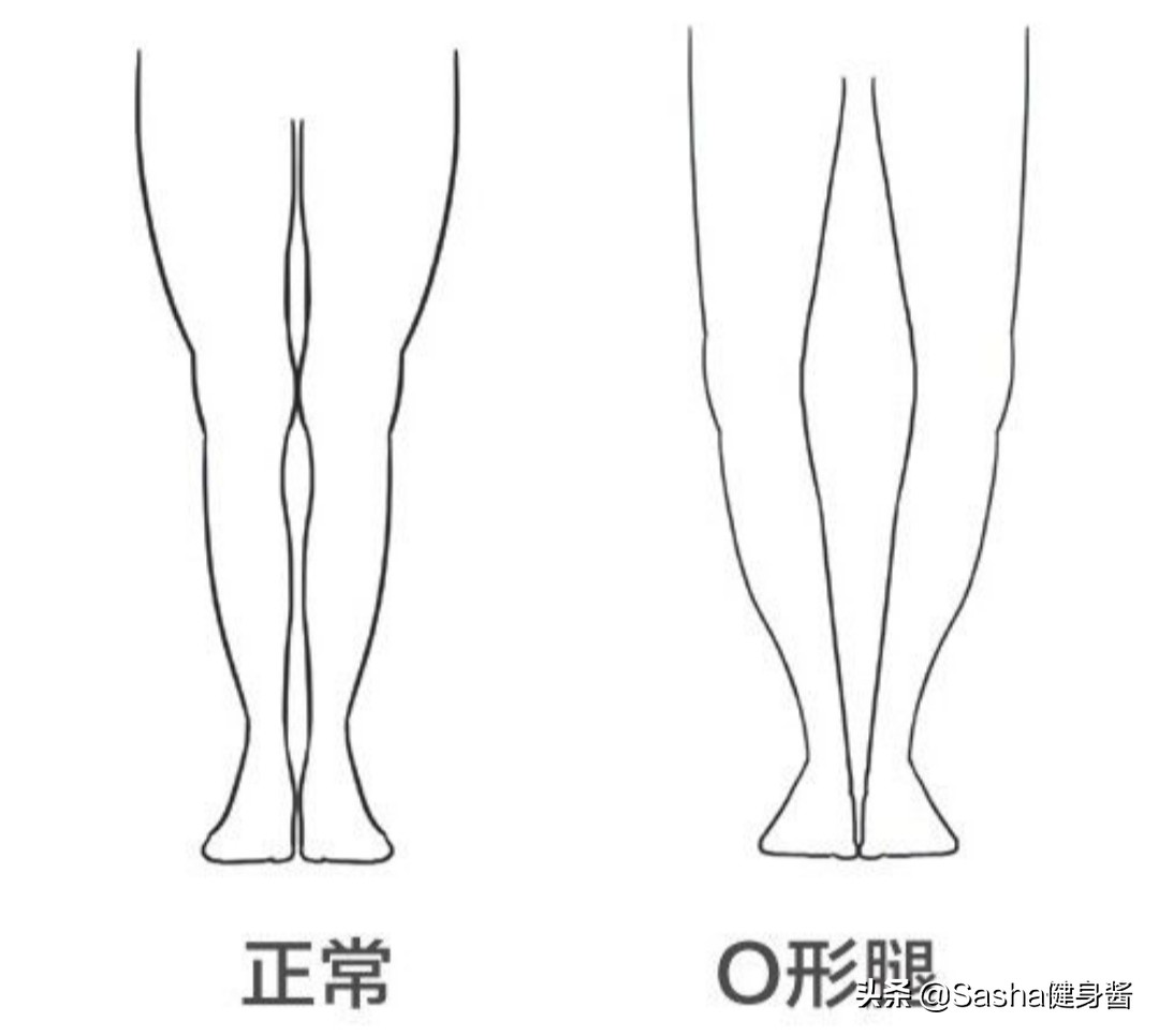 如何有效矫正o型腿,正确矫正o型腿的方法