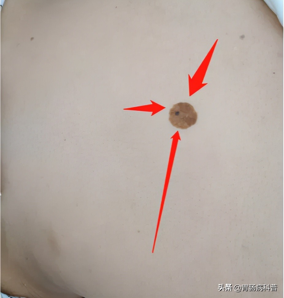 70岁老太太患上了癌症,老年人双下肢长出黑毛毛