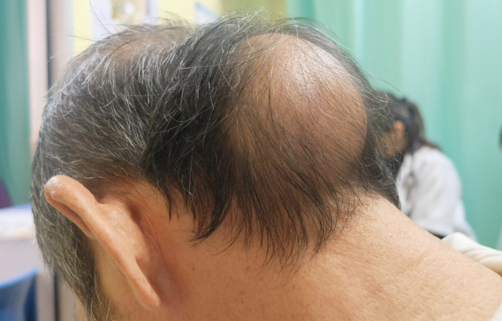 后脑勺发根处疙瘩是癌,后脑勺硬块怎么判断是不是肿瘤