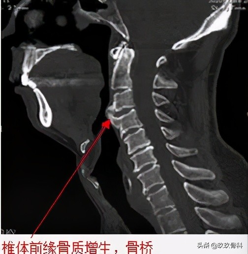 病例实讲|你是否也将其误诊为椎体骨折