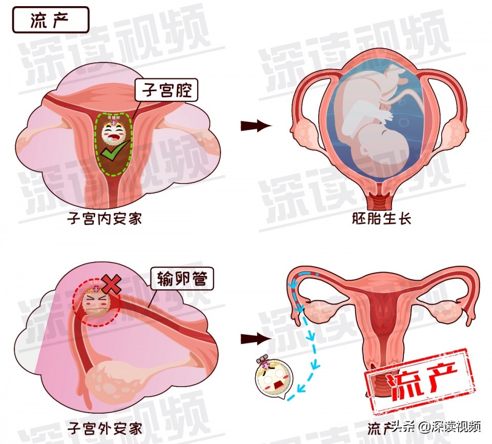关爱女性|3.8妇女节深读特别节目——《宫外孕专题》