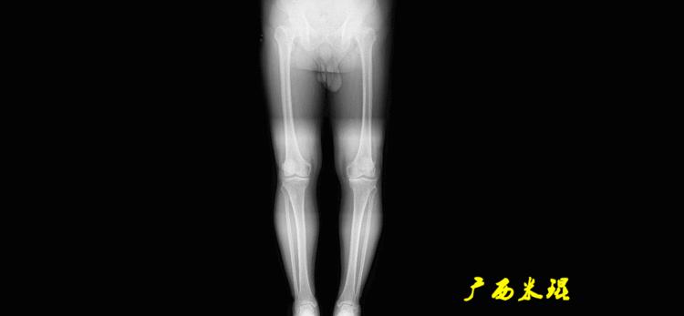 广西骨科医生米琨最新信息,米琨广西骨科什么水平