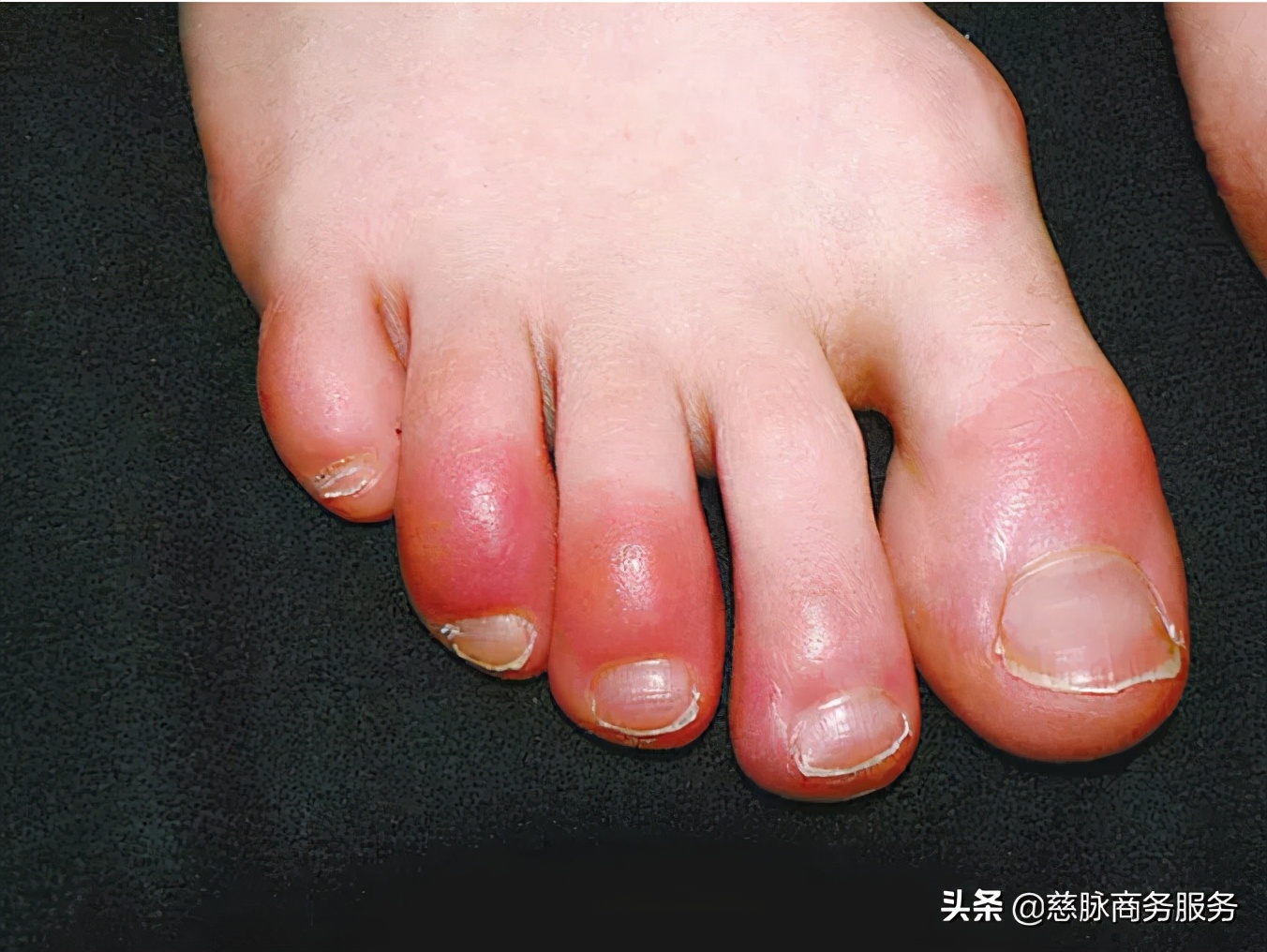 冻疮又痒又痛怎么办,长冻疮了又痛又痒怎么办