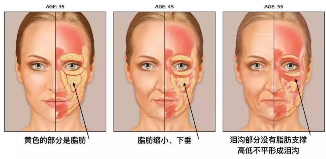 法令纹去除应该填充还是去皱,法令纹除了填充就没其他方法了吗